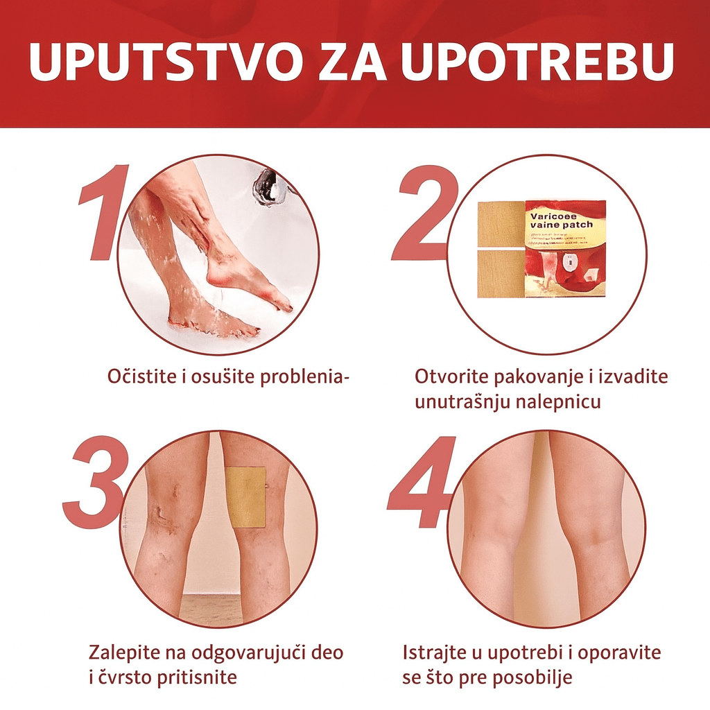 Flaster za proširene vene - Topopusti