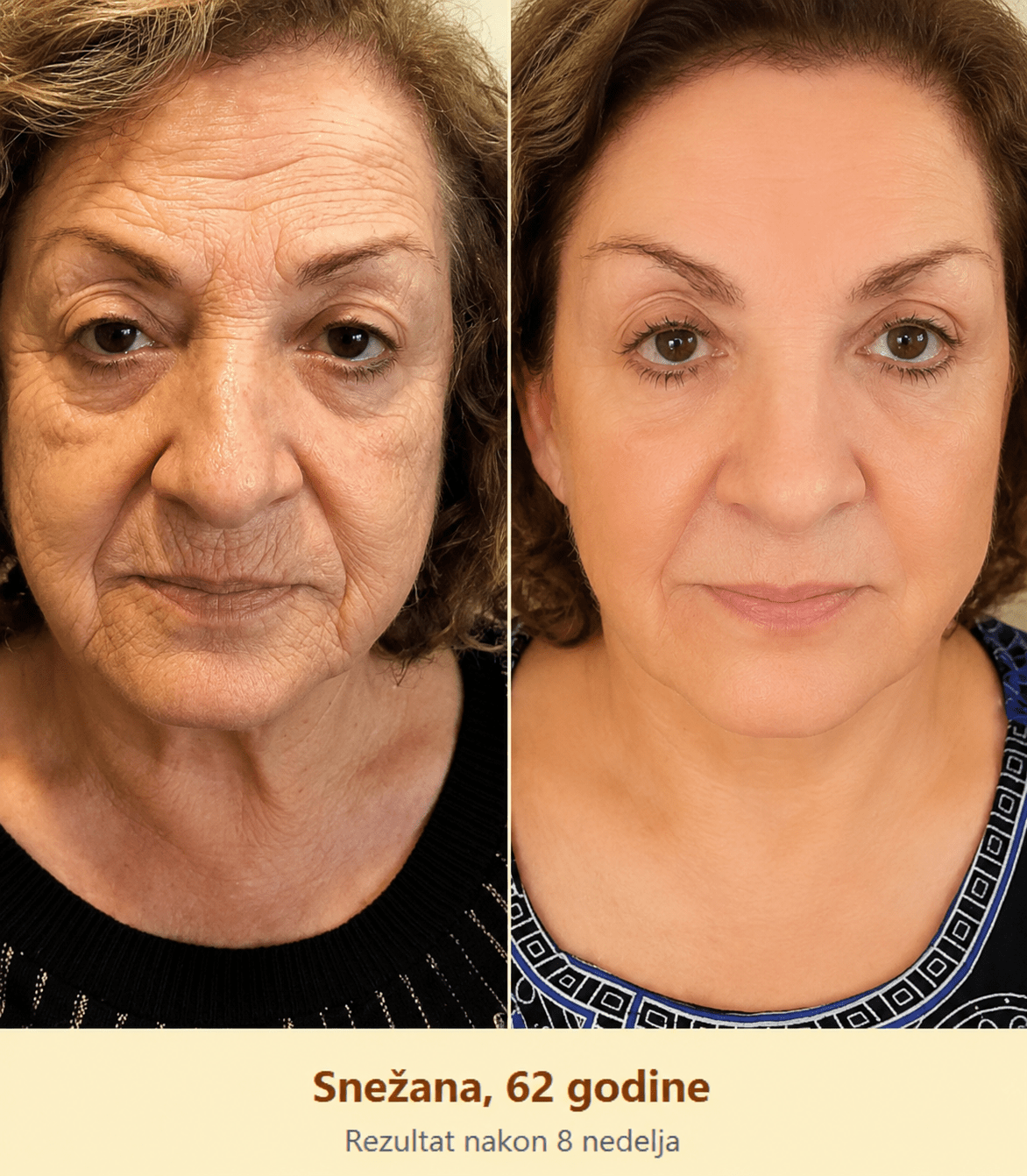 Pčelinji Otrov Krema - Anti-Age Serum - Topopusti